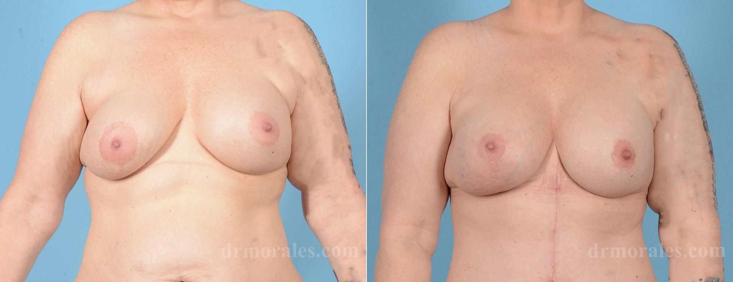 Before & After Breast Augmentation With Lift Case 74 View 1 View in Houston, TX