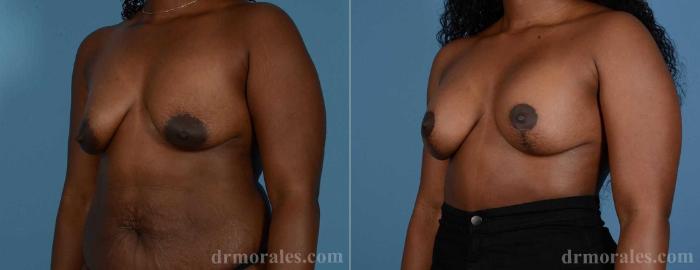 Before & After Breast Augmentation With Lift Case 76 View 1 View in Houston, TX