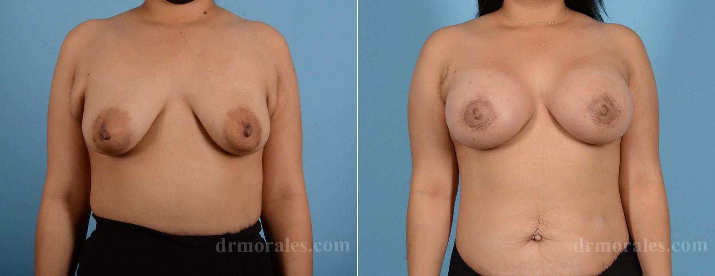 Before & After Breast Augmentation With Lift Case 77 View 1 View in Houston, TX