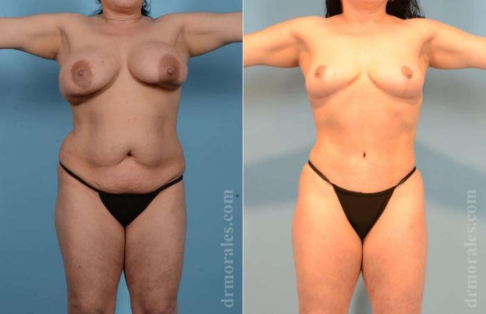 Before & After Breast Lift Case 19 View 1 View in Houston, TX