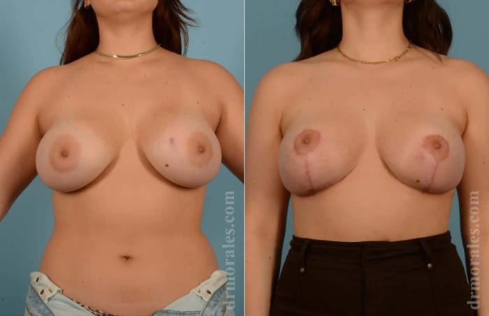 Before & After Breast Lift Case 2 View 1 View in Houston, TX