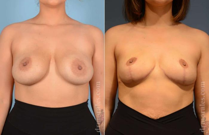 Before & After Breast Lift Case 4 View 1 View in Houston, TX
