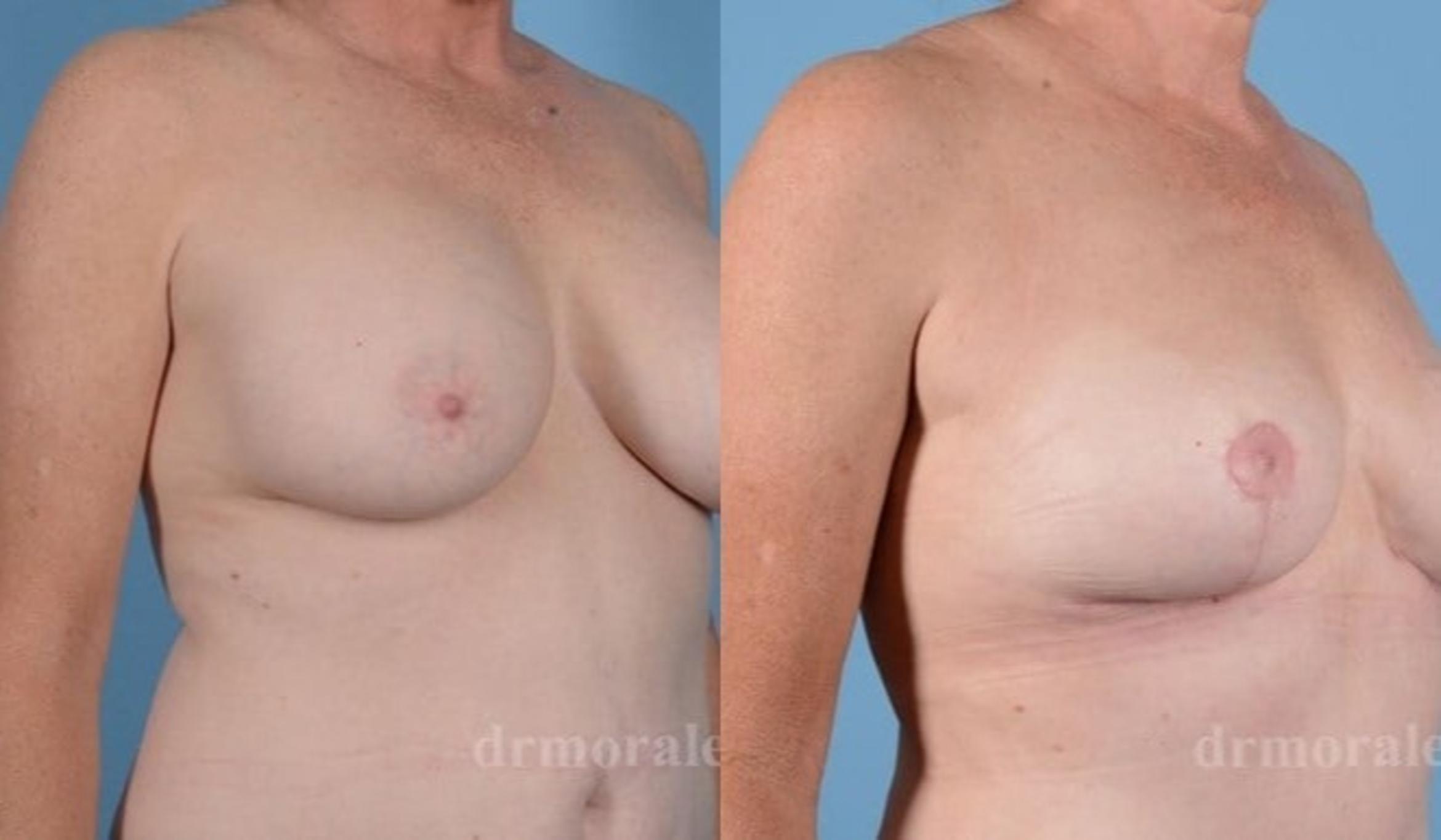 Before & After Fat Transfer Case 741 View 1 View in Houston, TX