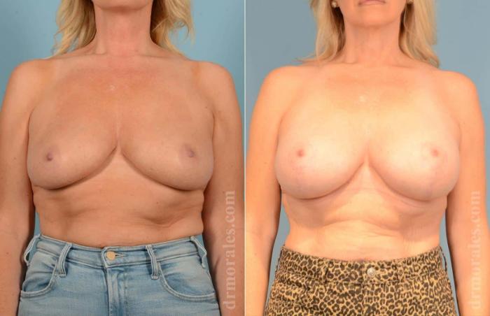 Before & After Breast Lift Case 11 View 1 View in Houston, TX