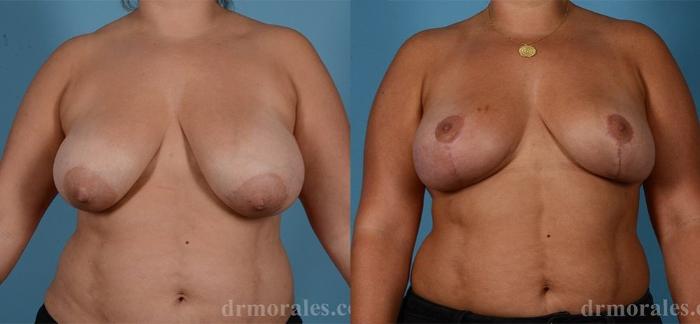 Before & After Breast Lift Case 463 View 1 View in Houston, TX