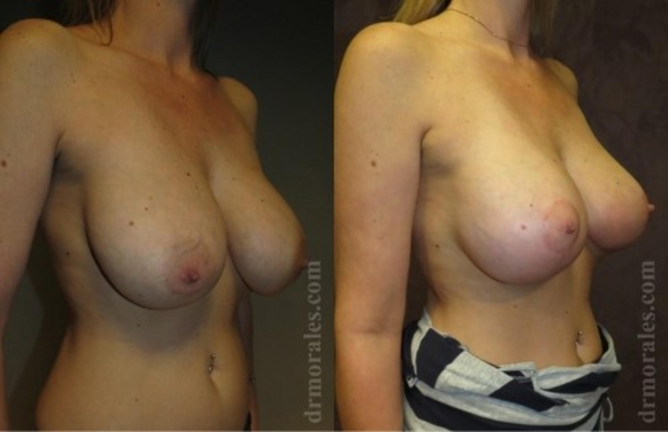 Before & After Breast Revision Case 613 View 1 View in Houston, TX