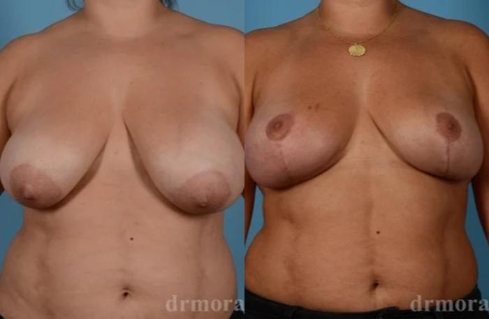 Before & After Liposuction Case 644 View 1 View in Houston, TX