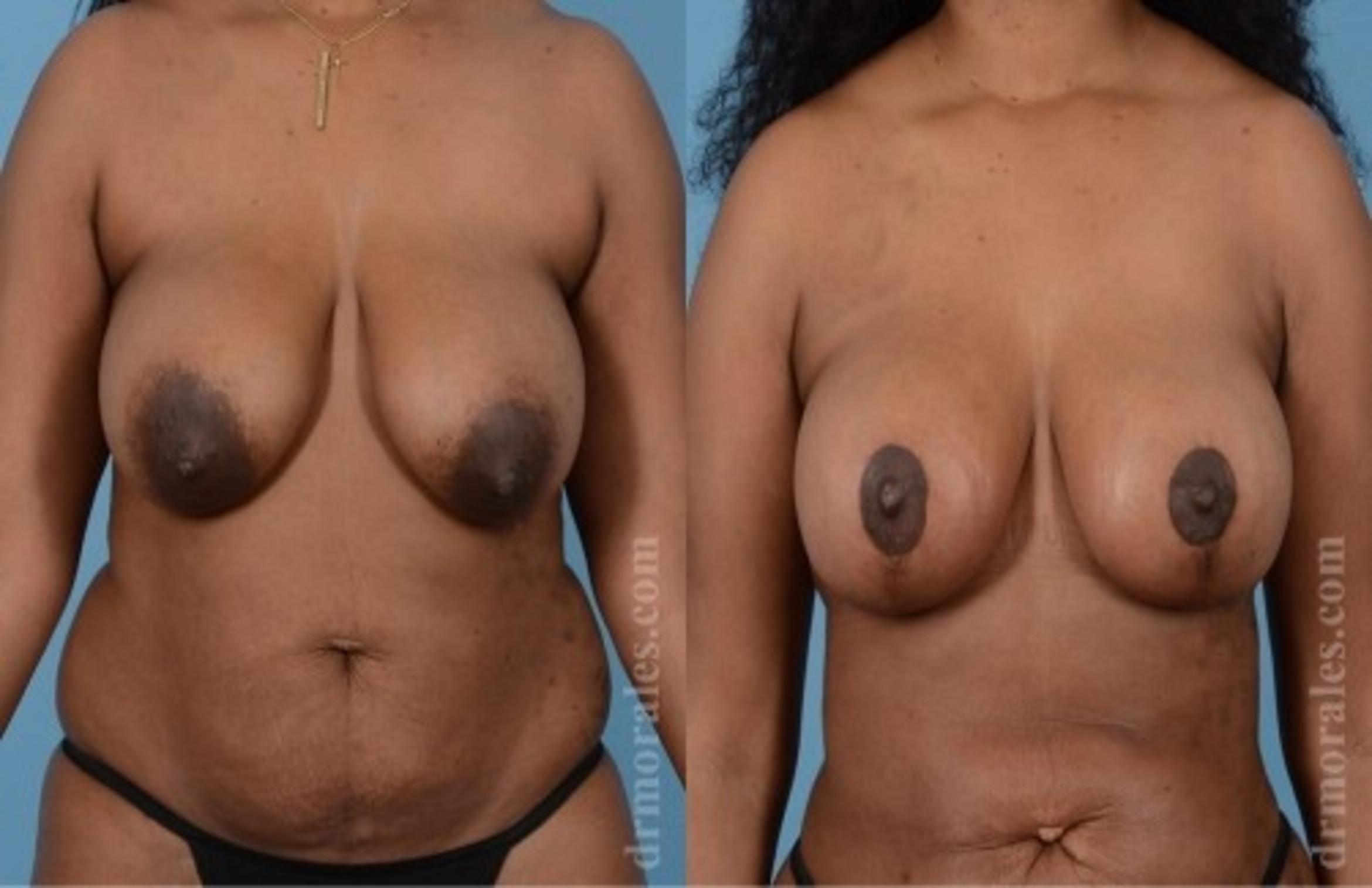 Before & After Breast Lift Case 720 View 1 View in Houston, TX