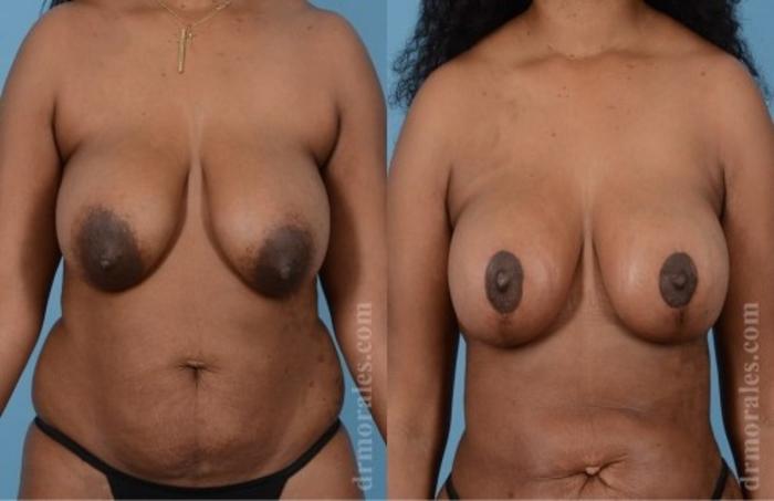 Before & After Breast Lift Case 720 View 1 View in Houston, TX