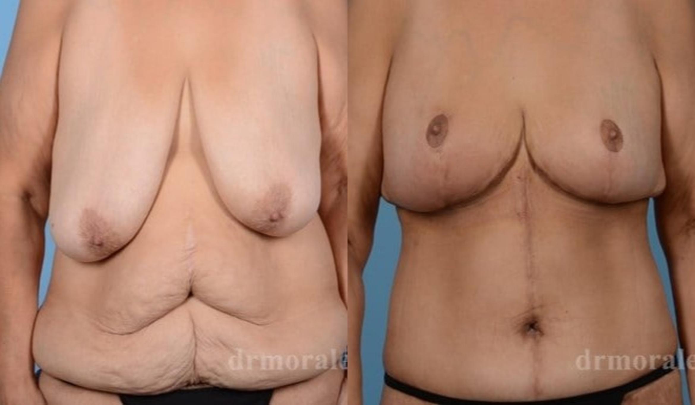 Before & After Breast Lift Case 721 View 1 View in Houston, TX