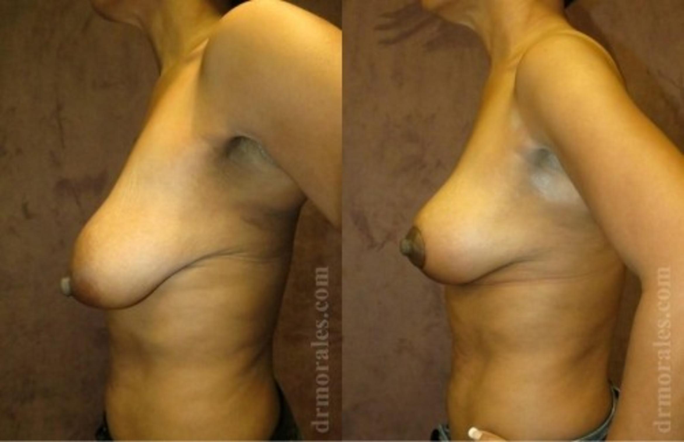 Before & After Breast Lift Case 723 View 1 View in Houston, TX
