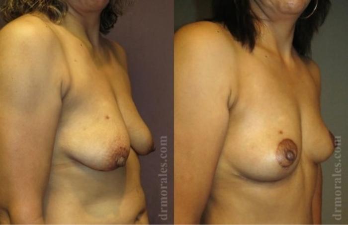 Before & After Breast Lift Case 724 View 1 View in Houston, TX