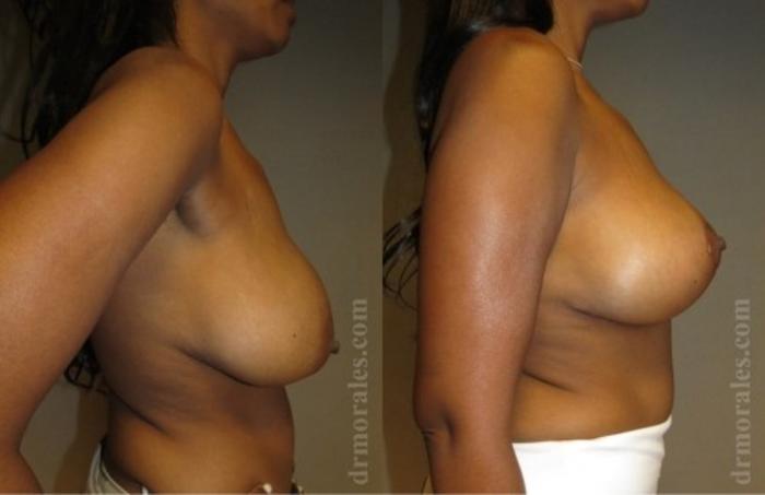 Before & After Breast Lift Case 725 View 1 View in Houston, TX