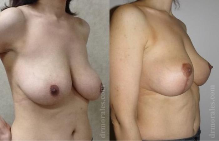 Before & After Breast Lift Case 726 View 1 View in Houston, TX