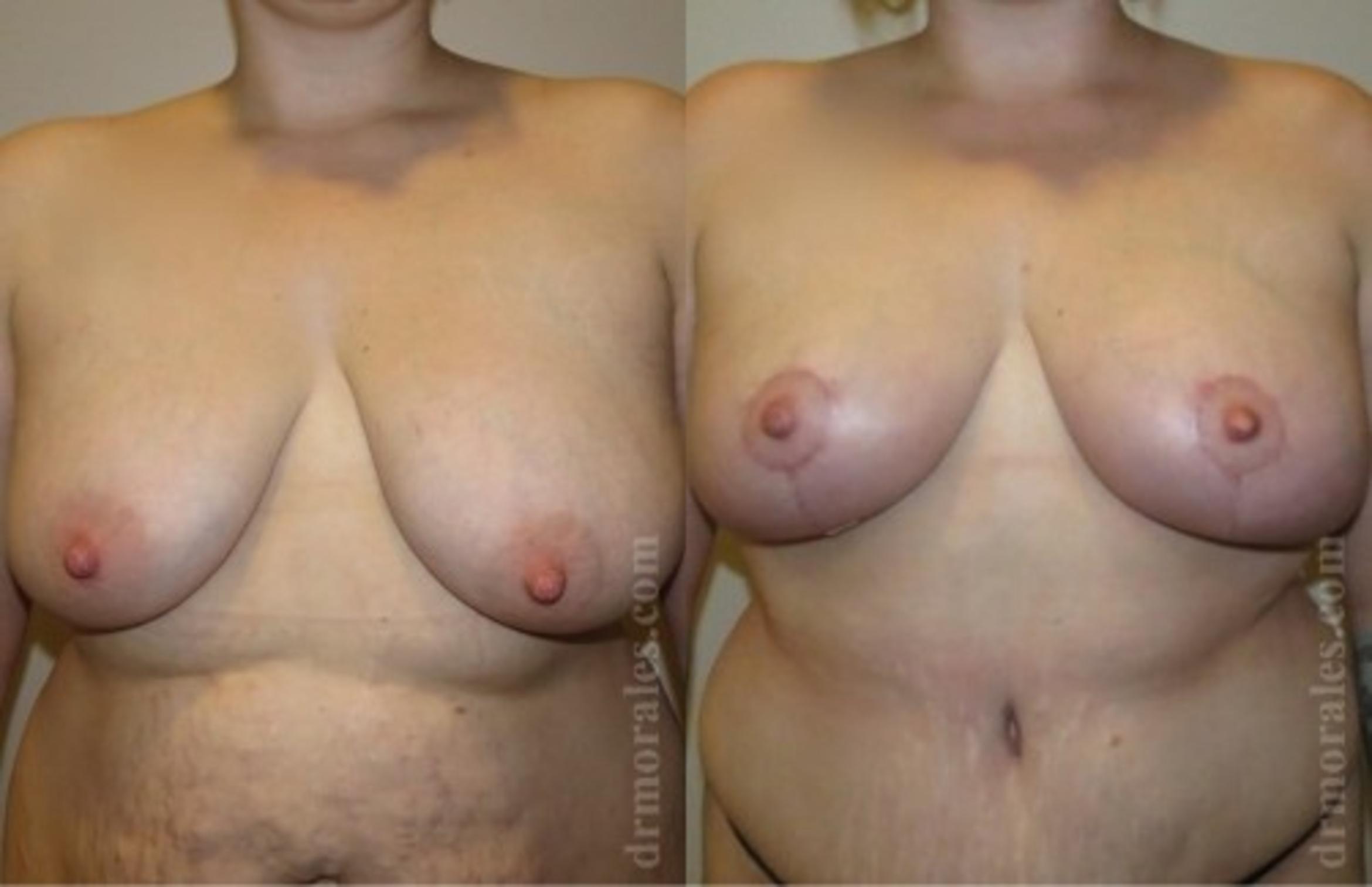 Before & After Breast Lift Case 727 View 1 View in Houston, TX