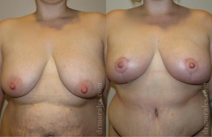 Before & After Breast Lift Case 727 View 1 View in Houston, TX