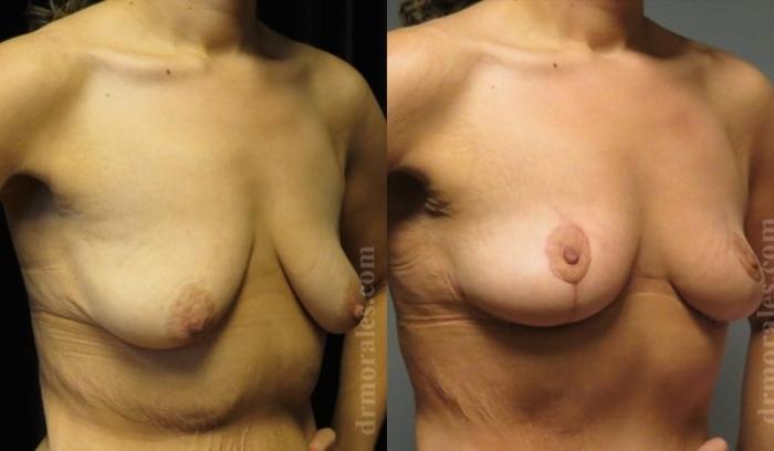 Before & After Breast Lift Case 728 View 1 View in Houston, TX