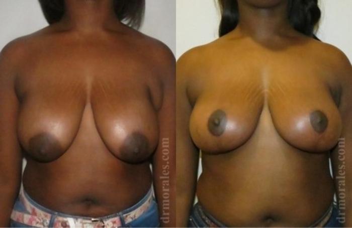 Before & After Breast Lift Case 729 View 1 View in Houston, TX