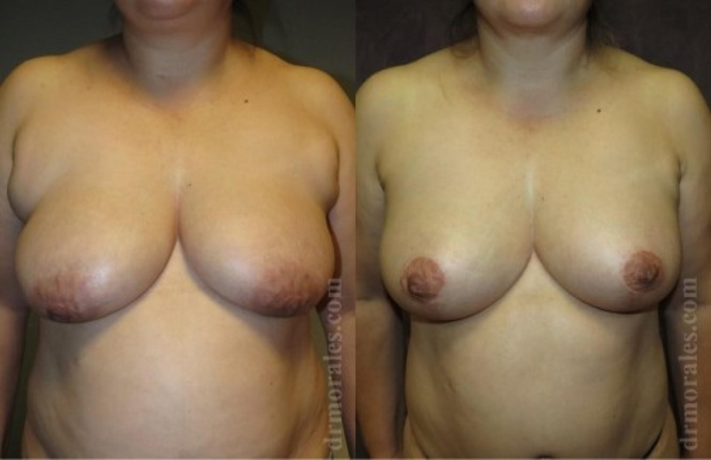 Before & After Breast Lift Case 730 View 1 View in Houston, TX