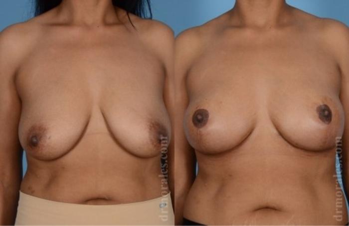 Before & After Breast Lift Case 731 View 1 View in Houston, TX
