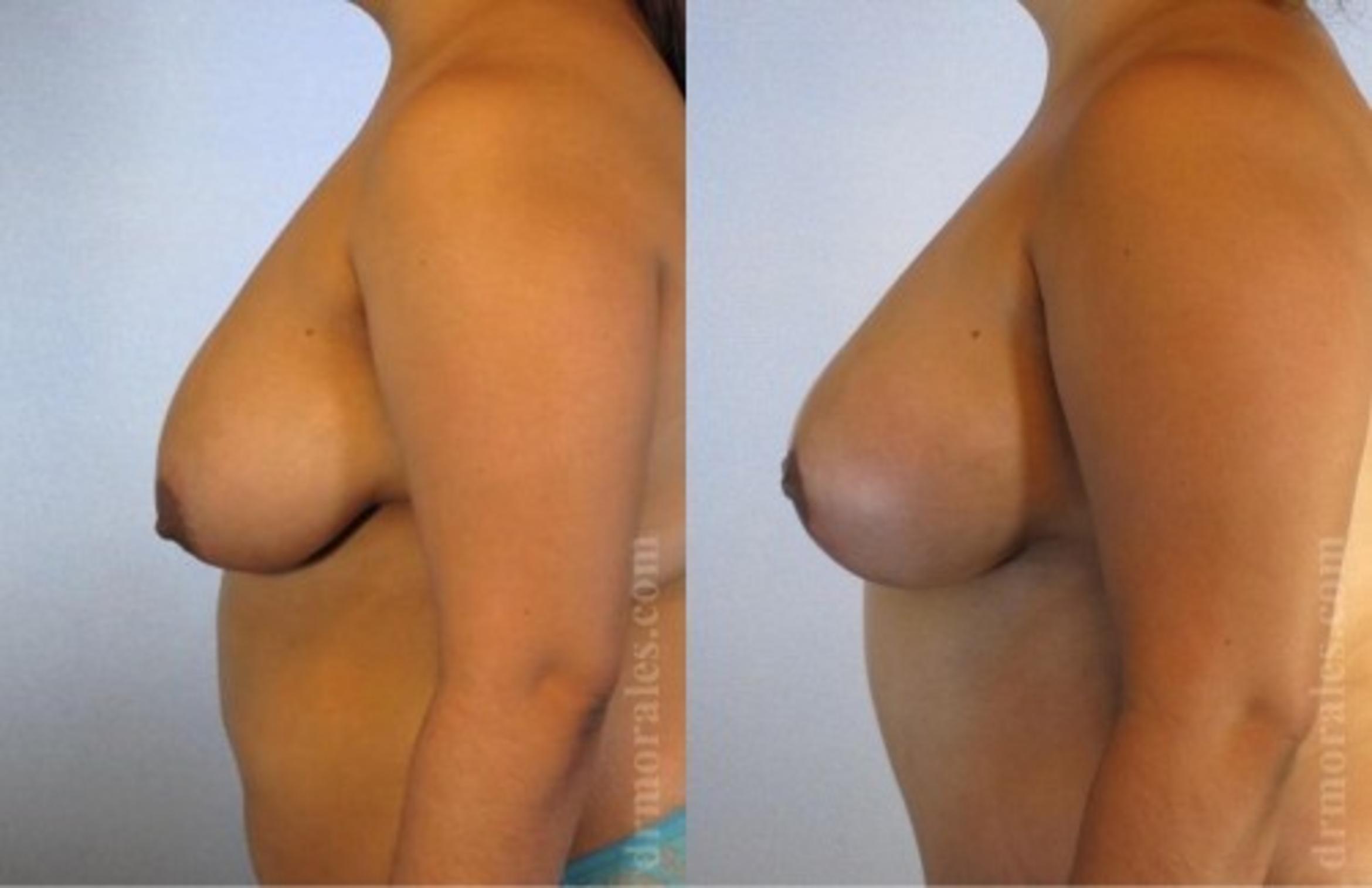 Before & After Breast Lift Case 732 View 1 View in Houston, TX