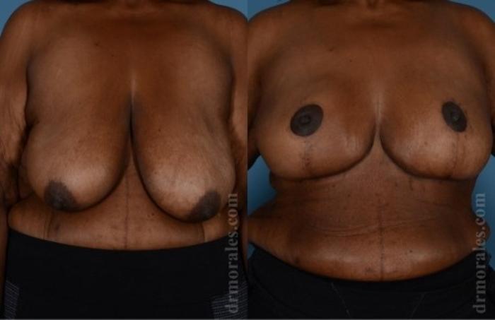 Before & After Breast Lift Case 733 View 1 View in Houston, TX