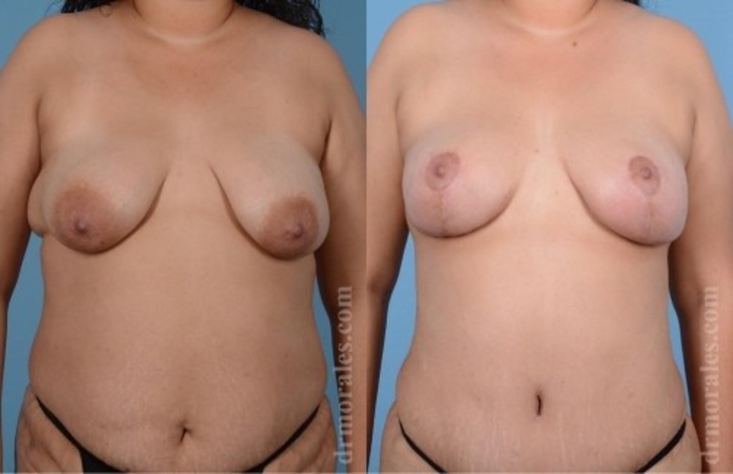 Before & After Breast Lift Case 736 View 1 View in Houston, TX