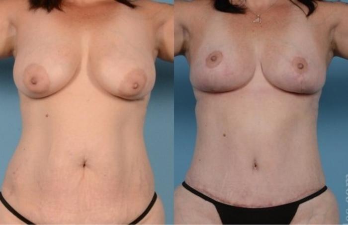 Before & After Breast Lift Case 737 View 1 View in Houston, TX