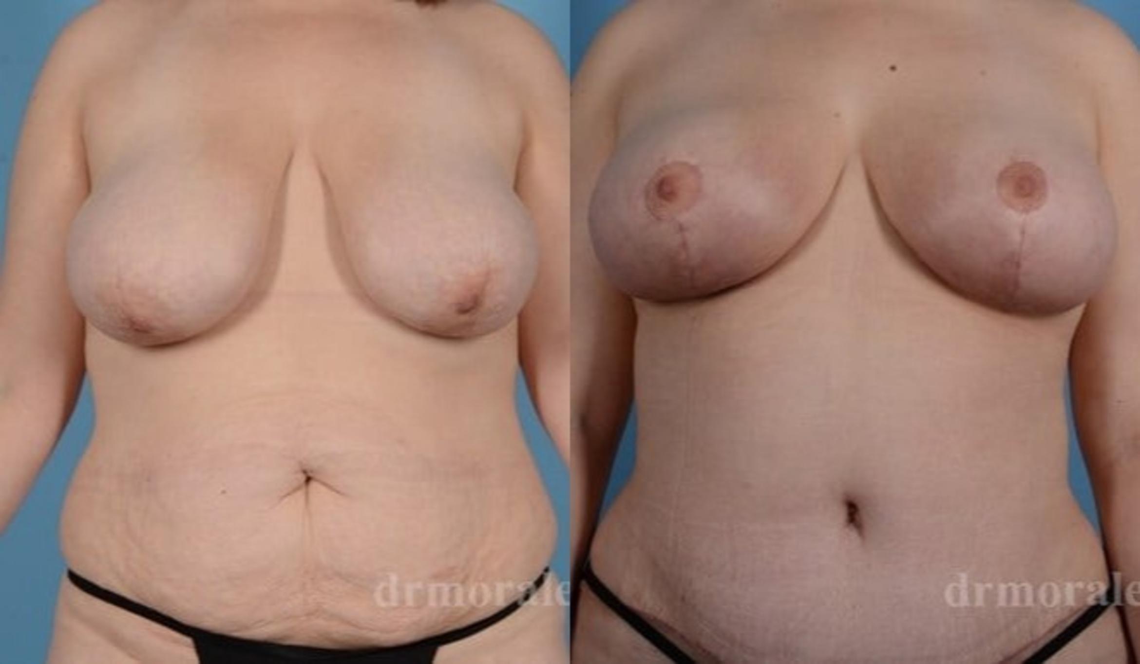 Before & After Breast Lift Case 738 View 1 View in Houston, TX