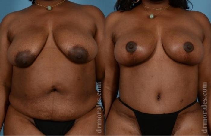 Before & After Breast Lift Case 743 View 1 View in Houston, TX