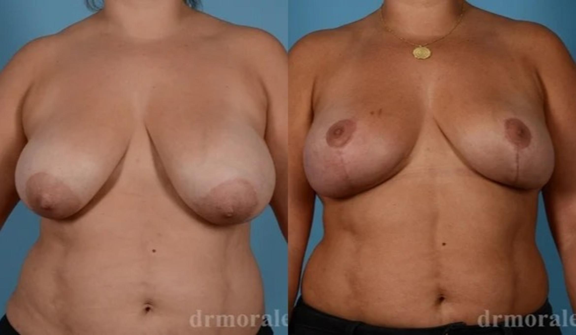 Before & After Breast Lift Case 744 View 1 View in Houston, TX