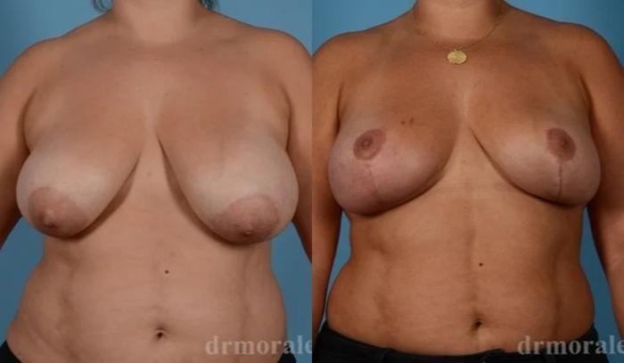 Before & After Breast Lift Case 744 View 1 View in Houston, TX