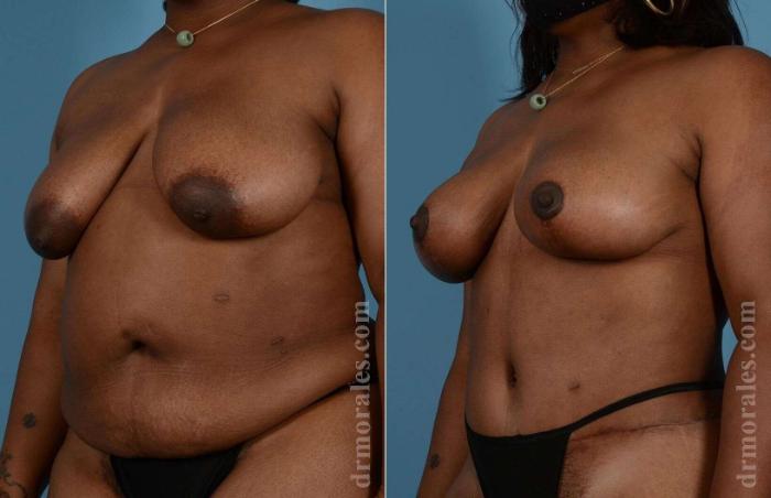 Before & After Breast Lift Case 78 View 1 View in Houston, TX