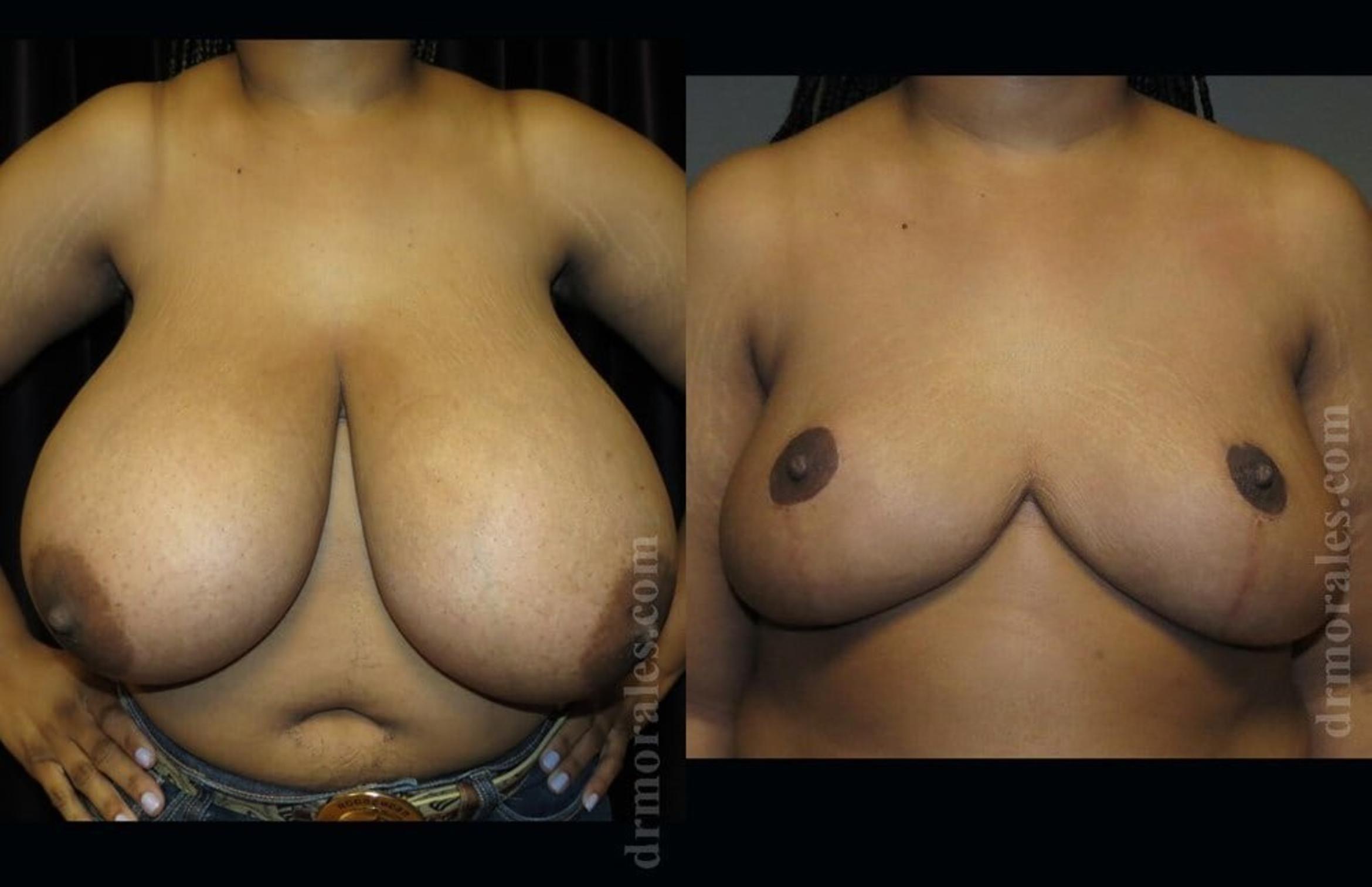 Before & After Breast Reduction Case 578 View 1 View in Houston, TX