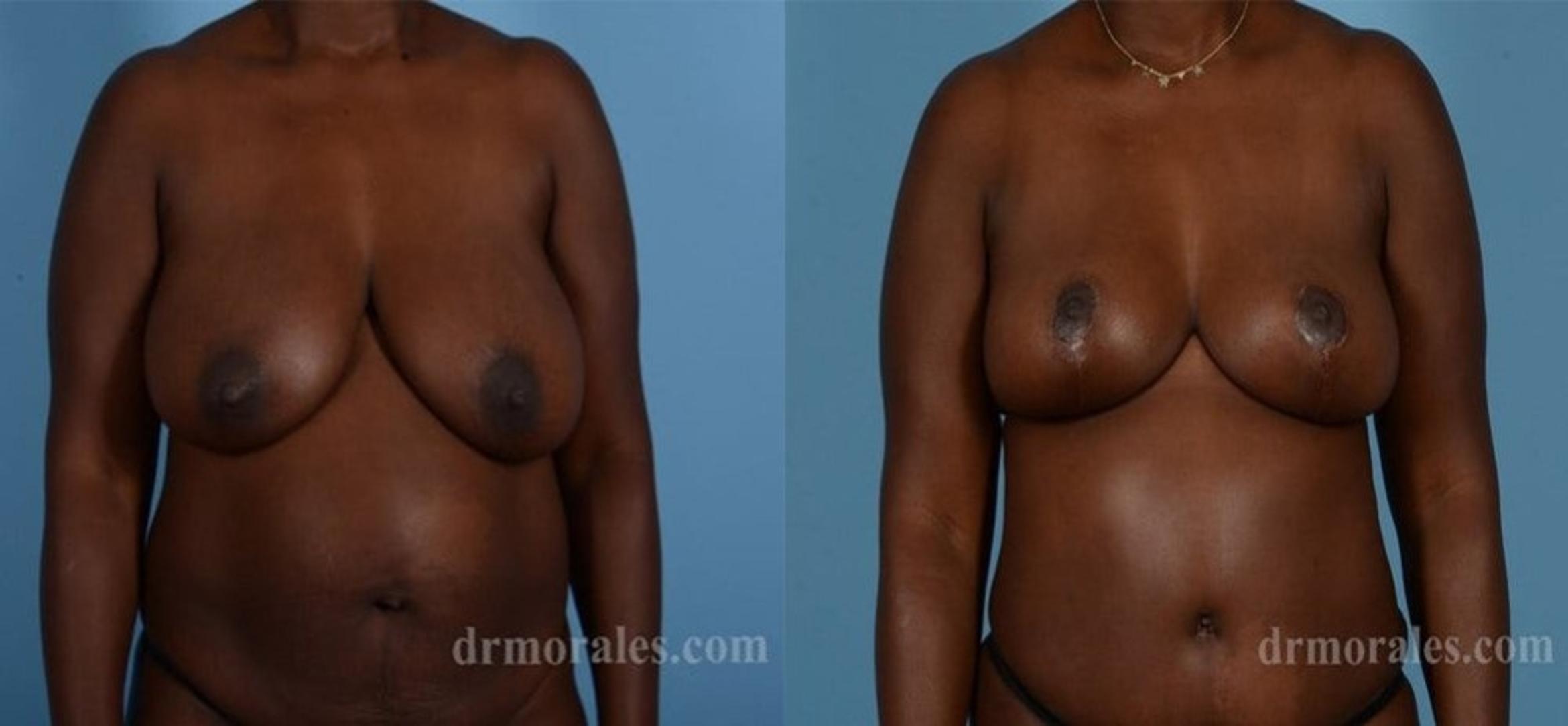 Before & After Breast Reduction Case 579 View 1 View in Houston, TX