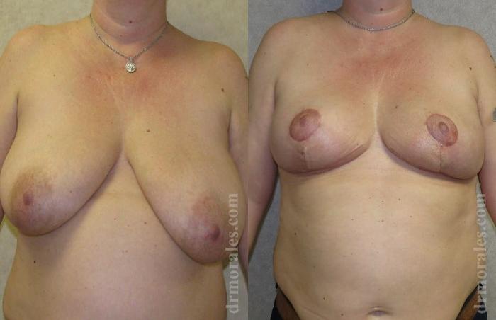 Before & After Breast Reduction Case 627 View 1 View in Houston, TX