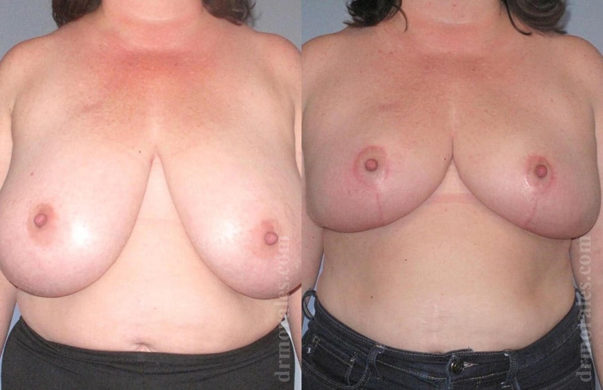 Before & After Breast Reduction Case 629 View 1 View in Houston, TX