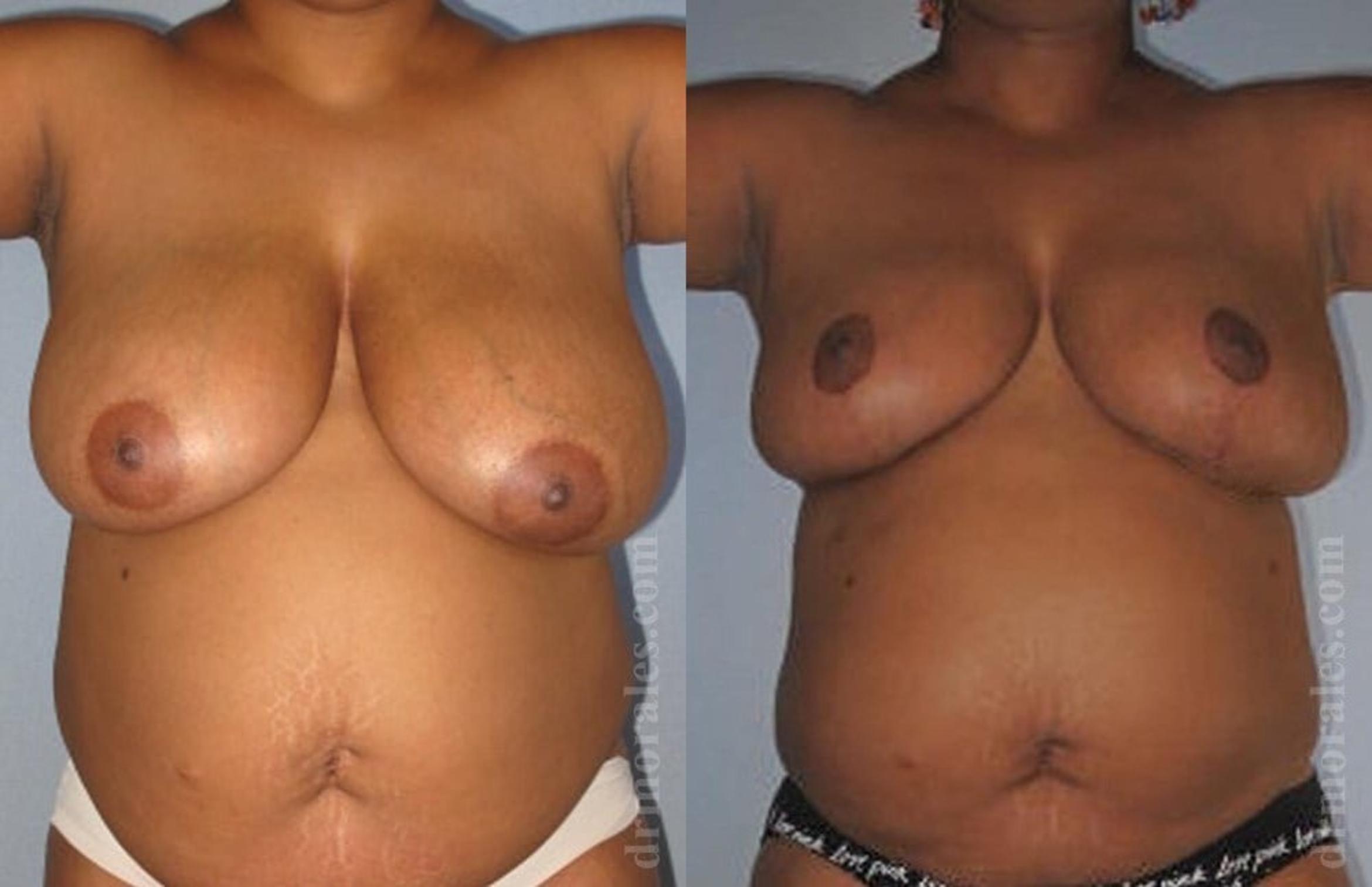 Before & After Breast Reduction Case 630 View 1 View in Houston, TX