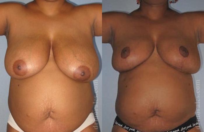 Before & After Breast Reduction Case 630 View 1 View in Houston, TX