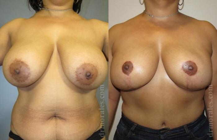 Before & After Breast Reduction Case 631 View 1 View in Houston, TX