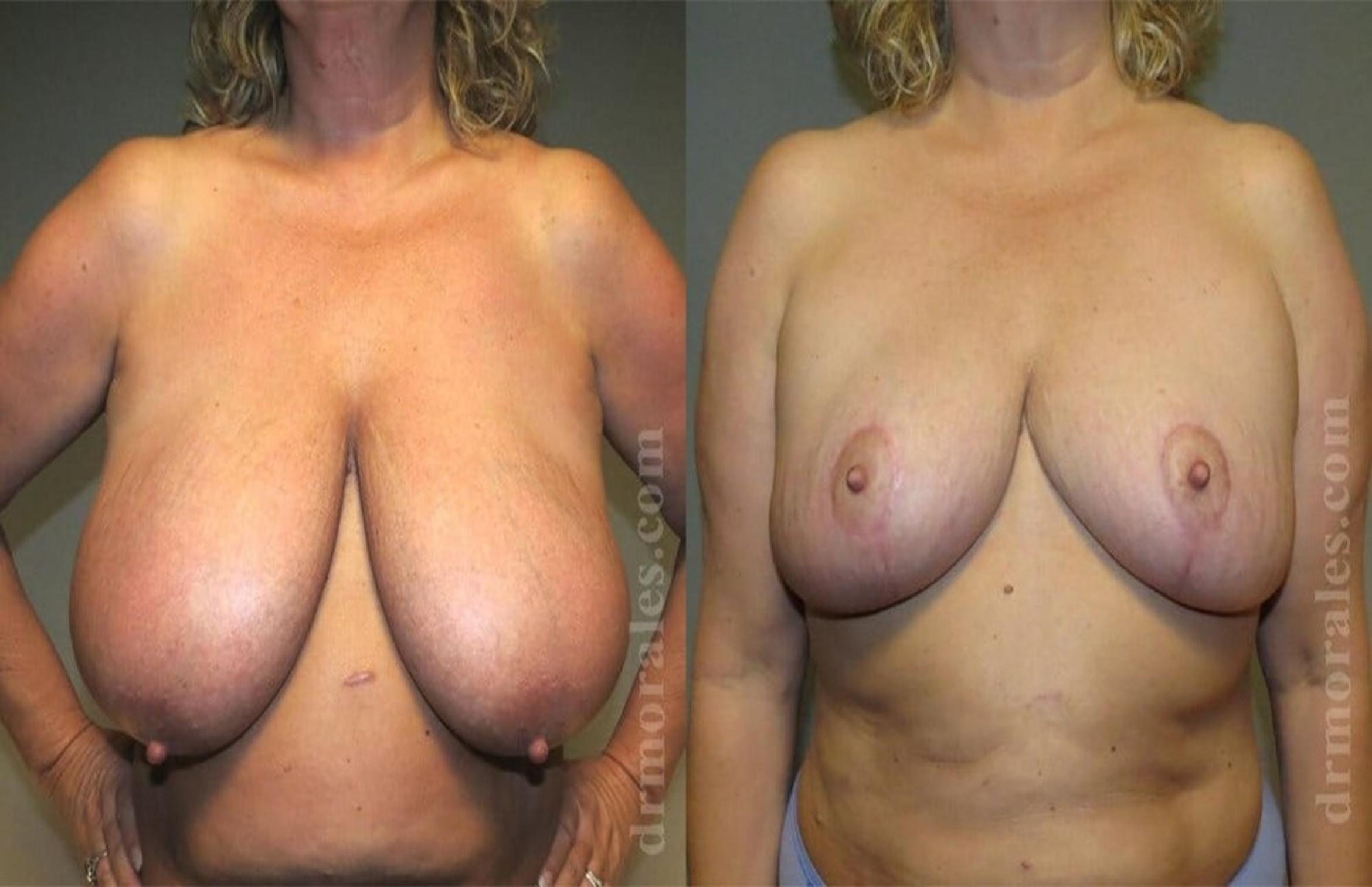 Before & After Breast Reduction Case 632 View 1 View in Houston, TX