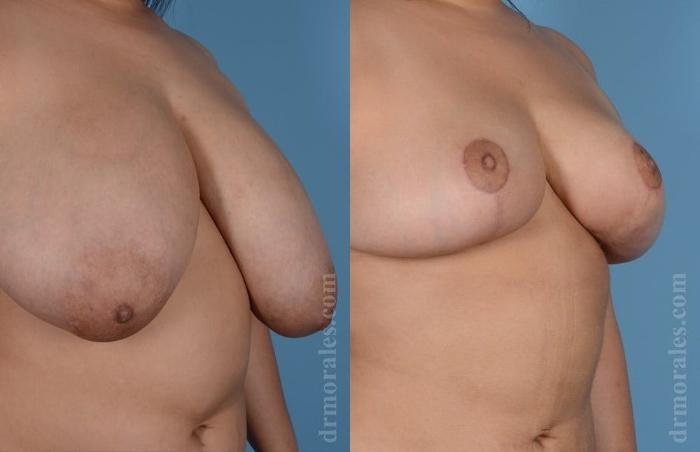 Before & After Breast Reduction Case 633 View 1 View in Houston, TX