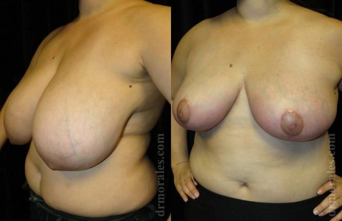 Before & After Breast Reduction Case 634 View 1 View in Houston, TX