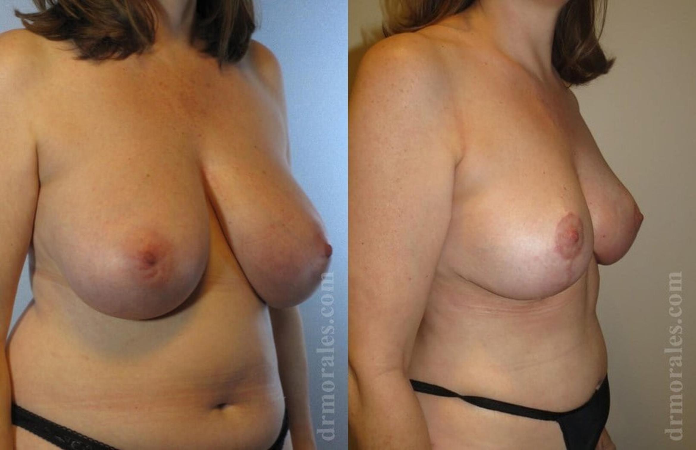 Before & After Breast Reduction Case 636 View 1 View in Houston, TX