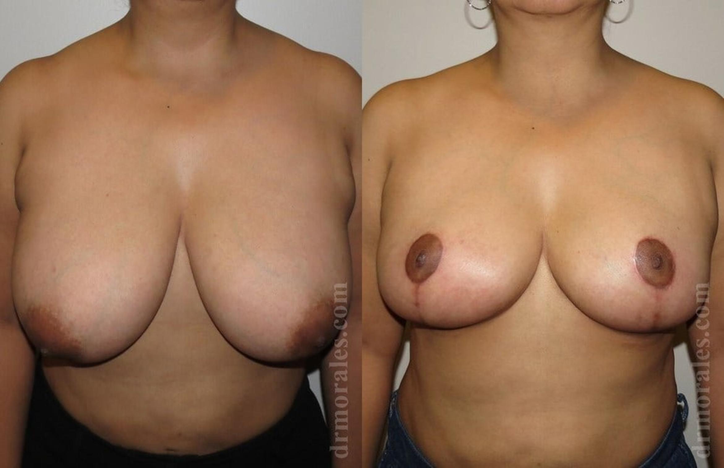 Before & After Breast Reduction Case 637 View 1 View in Houston, TX