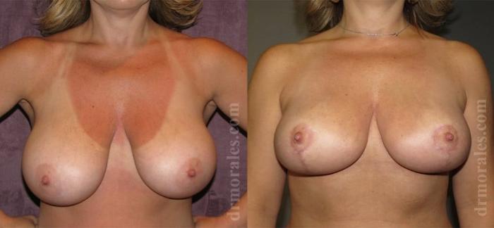 Before & After Breast Reduction Case 638 View 1 View in Houston, TX