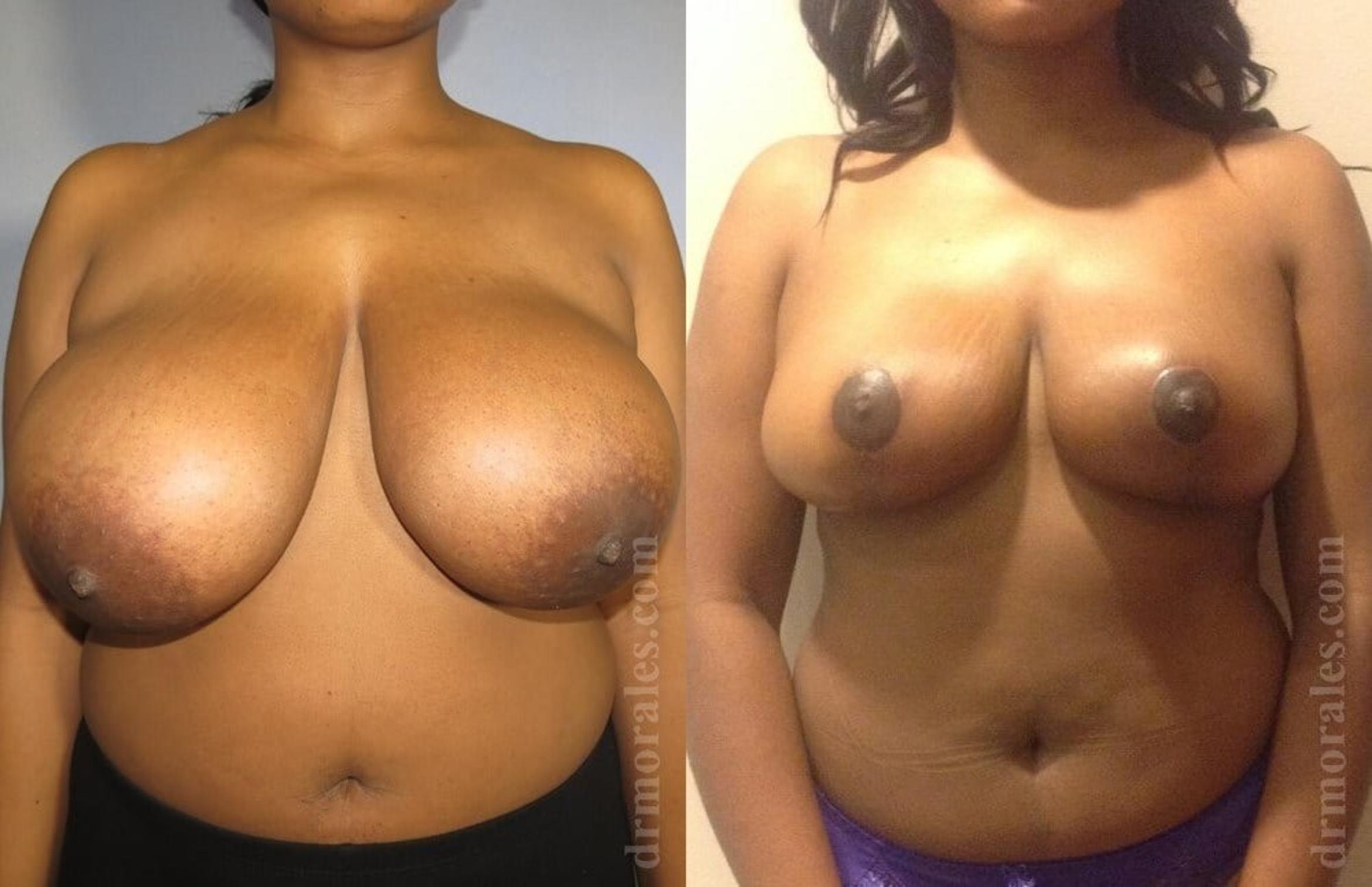 Before & After Breast Reduction Case 639 View 1 View in Houston, TX