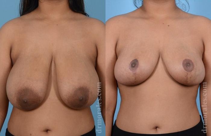 Before & After Breast Reduction Case 640 View 1 View in Houston, TX