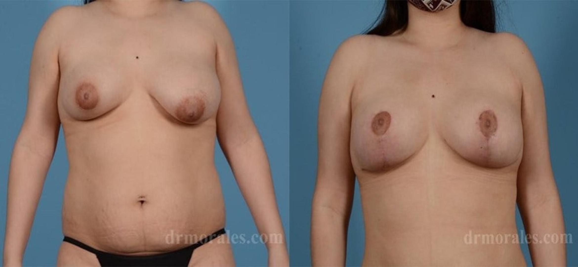 Before & After Breast Reduction Case 641 View 1 View in Houston, TX