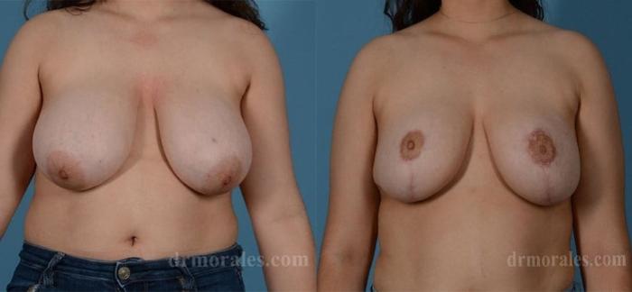 Before & After Breast Reduction Case 642 View 1 View in Houston, TX